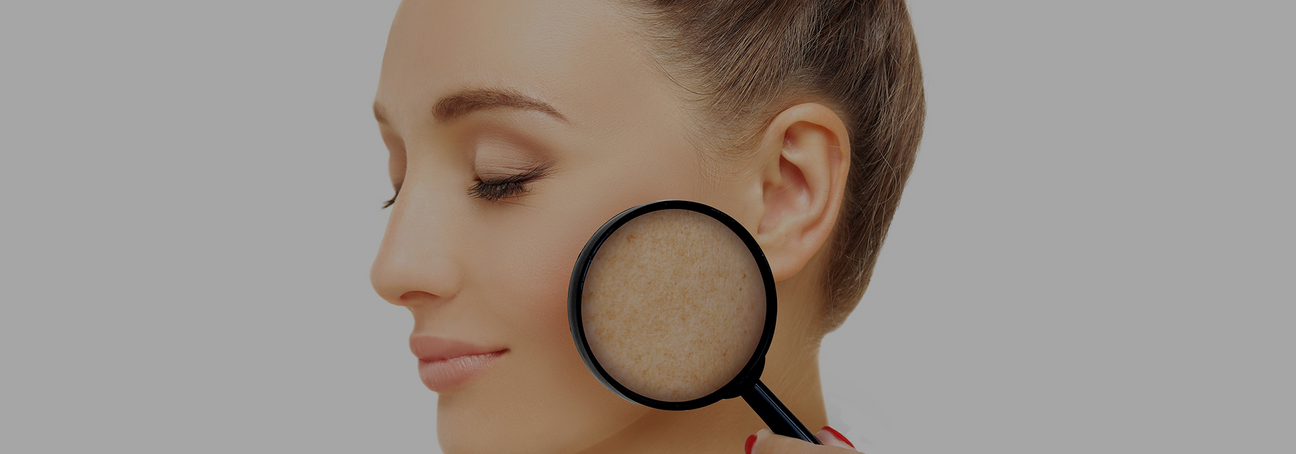 cream for dark spots