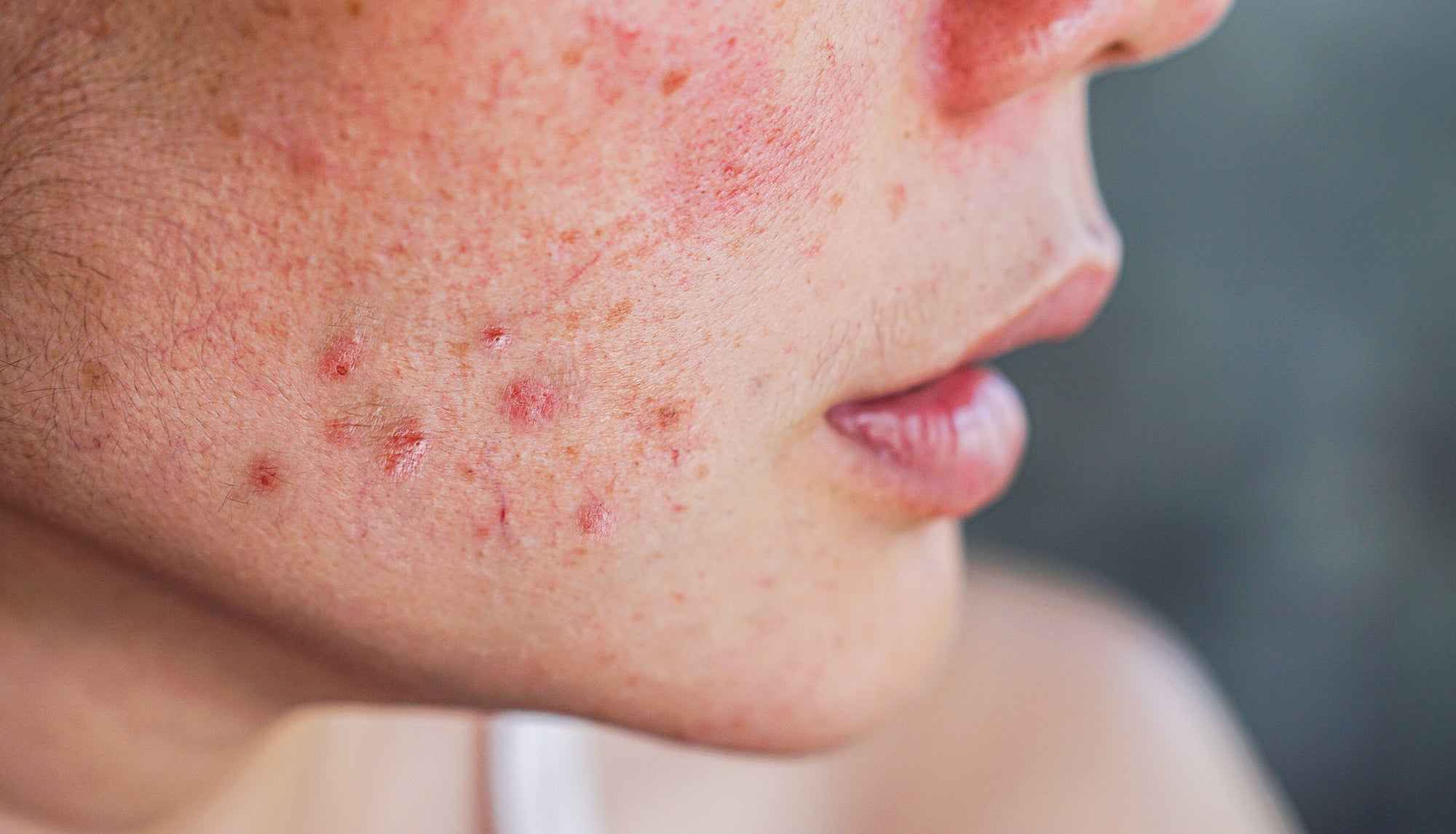 How to Prevent Acne Scarring | Minimise Acne Scars | Medical-Grade Skincare for Acne-Prone Skin | allmedic Australia