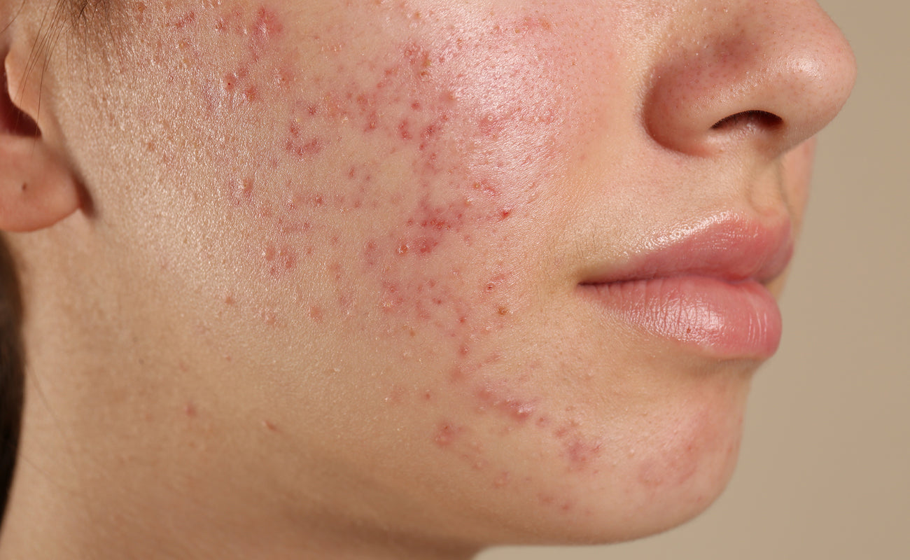 How To Get Rid Of Teenage Acne allmedic