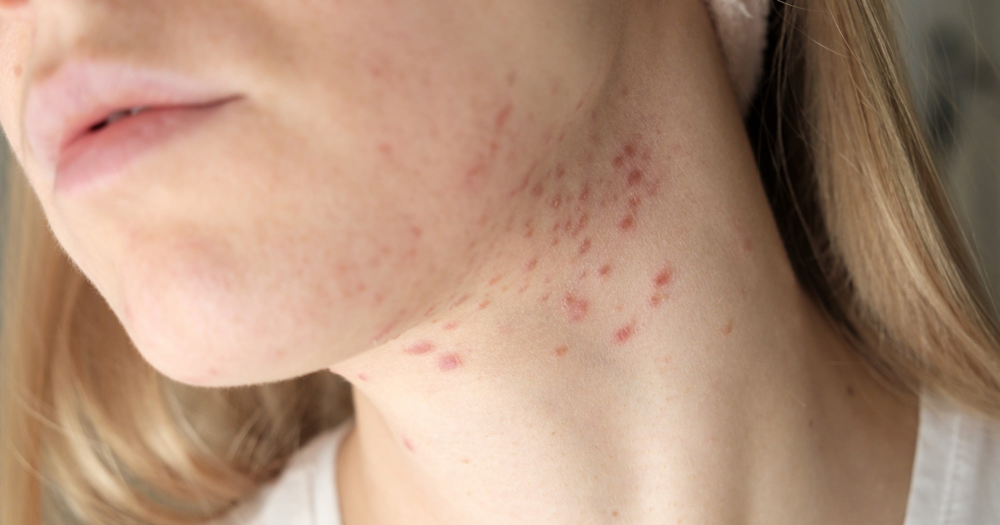 jawline acne acne on jawline jawline breakouts jawline pimples