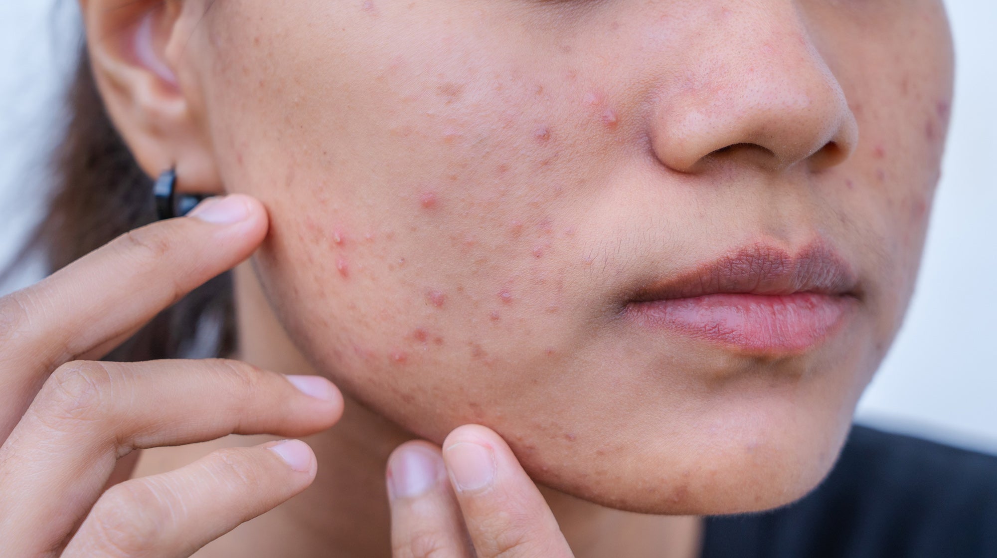 How to Reduce Red Pimples: Your Ultimate Guide to Clearer Skin How to Reduce Red Pimples: Your Ultimate Guide to Clearer Skin