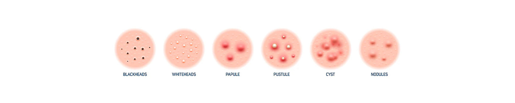 difference between acne and pimples acne vs pimples