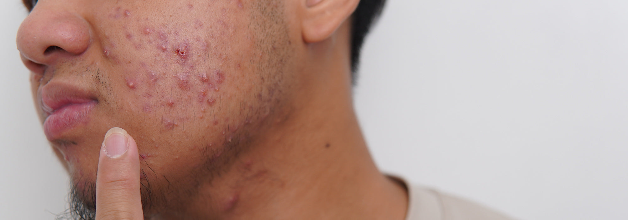 What are the Main Causes of Acne? | allmedic